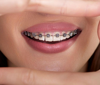 Chỉnh nha với hệ thống mắc cài trong điều trị của BS. Trương Thùy Trang