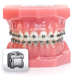 Mắc cài kim loại tự buộc trong điều trị chỉnh nha của BS. Trương Thùy Trang
