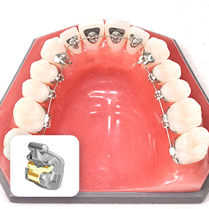 Mắc cài mặt trong được gắn phía trong răng trong điều trị chỉnh nha cùng BS. Trương Thùy Trang
