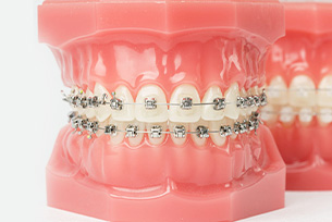 Chỉnh nha người trưởng thành bằng mắc cài kim loại cùng BS. Trương Thùy Trang