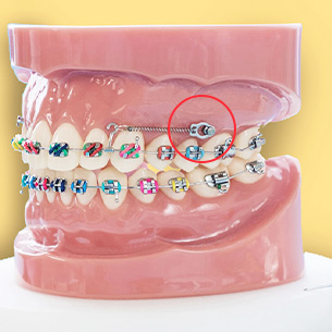 Chỉnh nha phối hợp cho người trưởng thành theo kế hoạch điều trị của BS. Trương Thùy Trang