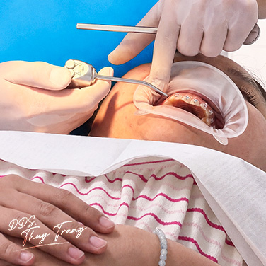 BS. Trương Thùy Trang điều chỉnh răng và khớp cắn trong chỉnh nha người trưởng thành