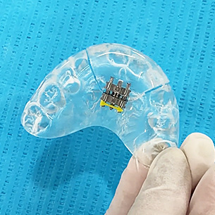 Khí cụ tăng trưởng được sử dụng trong chỉnh nha trẻ em theo chỉ định của BS. Trương Thùy Trang