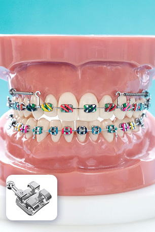 Mắc cài kim loại truyền thống trong chỉnh nha cùng BS. Trương Thùy Trang