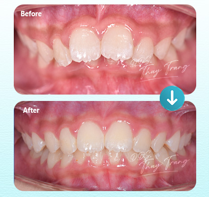 Ca 003157 chỉnh nha Invisalign với chen chúc nhẹ đến vừa vùng răng trước hai hàm và răng cửa xoay lệch