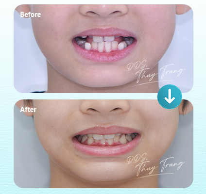 Ca 003246 chỉnh nha bệnh nhân trẻ trong giai đoạn răng hỗn hợp với chen chúc và lệch vị trí răng cửa