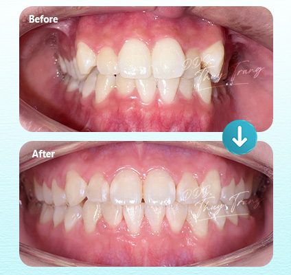 Ca 003264 chỉnh nha mắc cài tự đóng cùng BS. Trương Thùy Trang với chen chúc răng trước hai hàm và một số răng xoay lệch