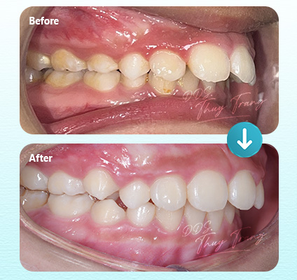 Ca 003348 chỉnh nha Invisalign với sai lệch khớp cắn bên nhẹ đến vừa và răng trước chưa đều