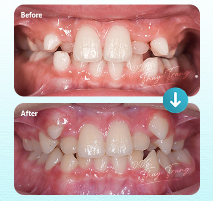 Ca 003531 chỉnh nha Invisalign với khoảng thưa, sai lệch vị trí răng trước hàm trên và một số răng mọc lệch