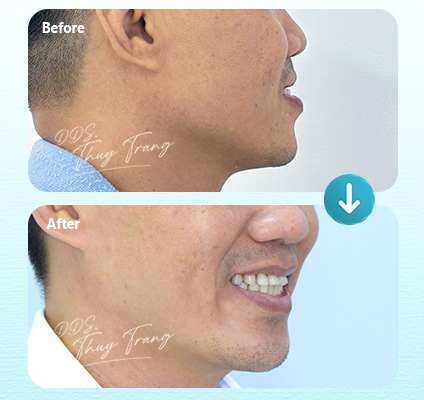 Ca 003608 chỉnh nha Invisalign cùng BS. Trương Thùy Trang với biểu hiện hô, môi nhô và profile chưa hài hòa
