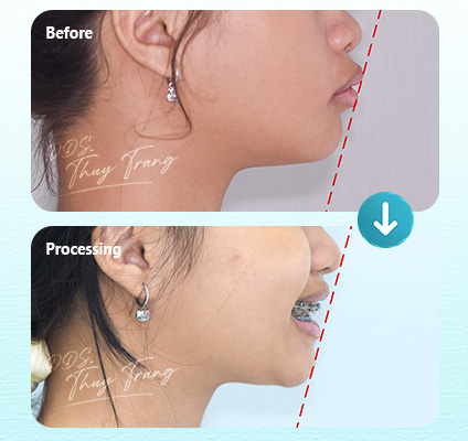 Ca 003654 chỉnh nha mắc cài sứ với profile lồi, môi nhô, răng trước chìa và khớp cắn chưa hài hòa