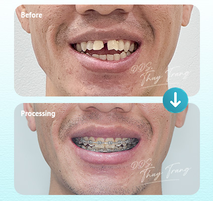 Ca 003672 chỉnh nha mắc cài tự đóng với răng trước mọc lệch, có khoảng và tương quan khớp cắn chưa cân đối