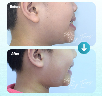Ca 003693 chỉnh nha mắc cài sứ với biểu hiện hô, profile lồi, môi nhô và cằm lùi tương đối