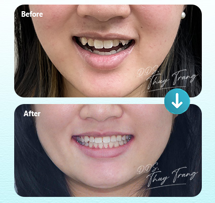 Ca 003731 chỉnh nha mắc cài sứ với răng trước mọc không đều, hướng đến sắp xếp răng cửa và cải thiện đường cười