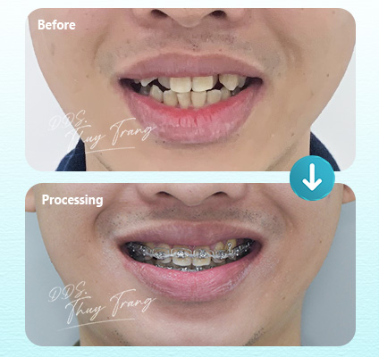 Ca 003764 chỉnh nha mắc cài kim loại với răng trước mọc lệch, chen chúc mức độ vừa và nụ cười chưa cân đối