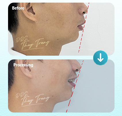 Ca 003856 chỉnh nha Invisalign với profile lồi, môi nhô và cằm lùi tương đối, tập trung cải thiện vị trí răng cửa và mặt nghiêng