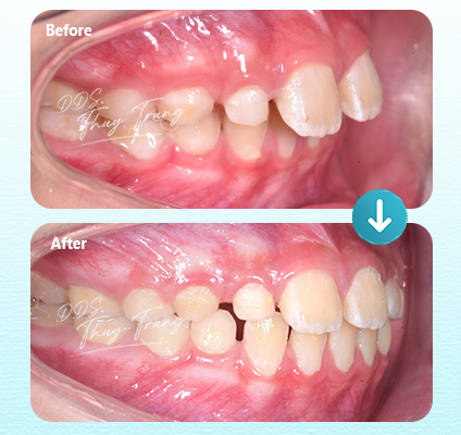 Ca 003905 chỉnh nha Invisalign cùng BS. Trương Thùy Trang với răng nanh và răng trước hàm trên mọc lệch, chen chúc khu trú