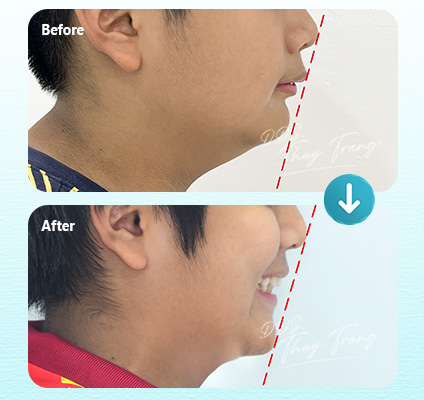 Ca 003917 chỉnh nha mắc cài tự đóng với biểu hiện hô, profile lồi, môi nhô và cằm lùi tương đối