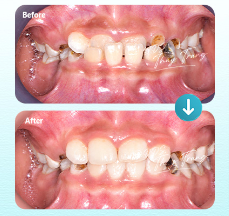 Ca chỉnh móm cho bệnh nhân tuổi teen cùng BS. Trương Thùy Trang