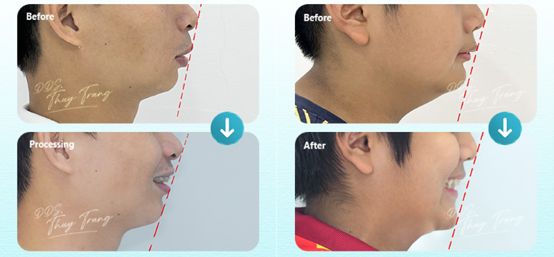 Hình ảnh góc nghiêng trước và trong quá trình chỉnh nha hô trong ca điều trị của BS. Trương Thùy Trang