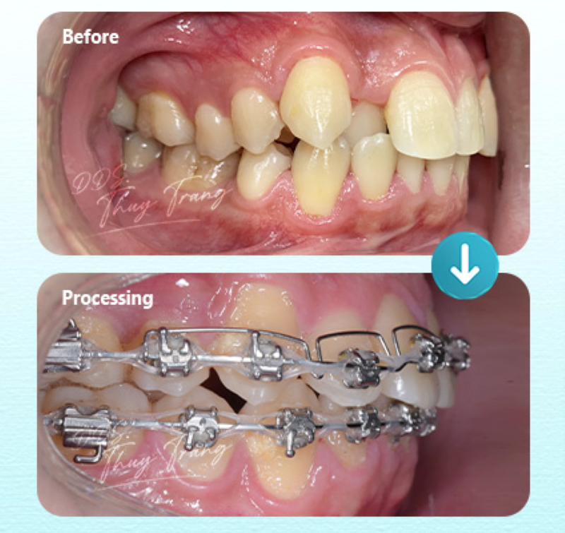 Ca chỉnh nha đang điều trị có nhổ răng theo kế hoạch cá nhân hóa