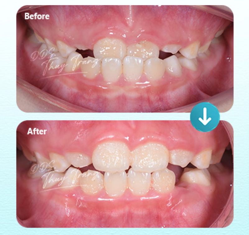 Hình ảnh trước và sau điều trị cắn ngược ở trẻ trong chỉnh nha