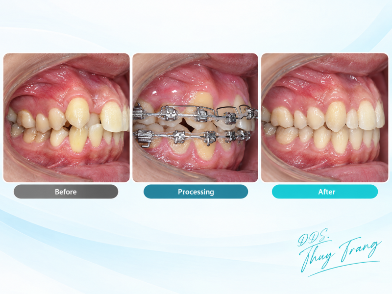 Ca chỉnh nha trước, trong và sau điều trị cùng BS. Trương Thùy Trang