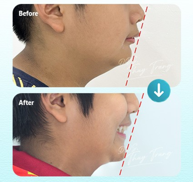 Ca điều trị hô cải thiện mặt nghiêng cùng BS. Trương Thùy Trang
