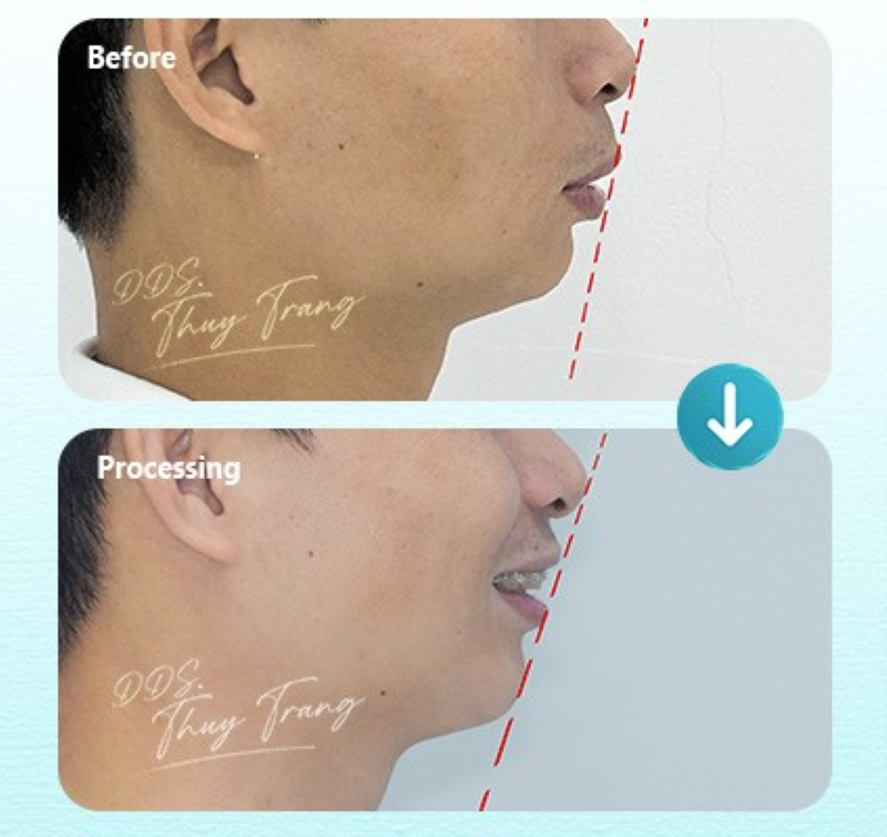 -một ca hô do xương chủ yếu sau 14 tháng điều trị với mắc cài sứ thường – BS. Trương Thùy Trang