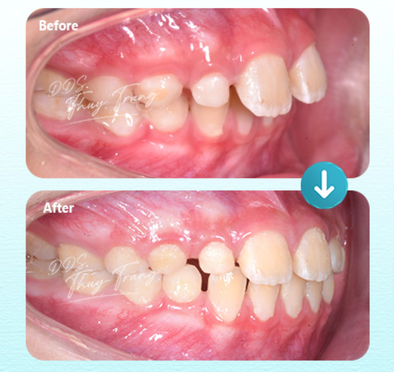 Hình ảnh trước và sau điều trị cắn chéo vùng răng nanh – răng sau bằng mắc cài kim loại, không nhổ răng