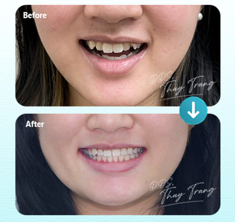 Hình ảnh trước và sau điều trị cắn hở vùng răng trước bằng mắc cài kim loại không nhổ răng