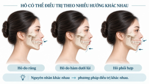 Minh họa các hướng điều trị hô theo nguyên nhân gồm hô do răng, hàm dưới lùi và hô phối hợp