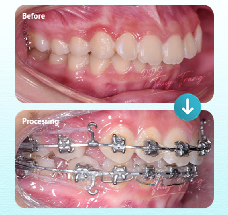 Ca chỉnh nha có nhổ răng để tạo khoảng trong quá trình điều trị cùng BS. Trương Thùy Trang