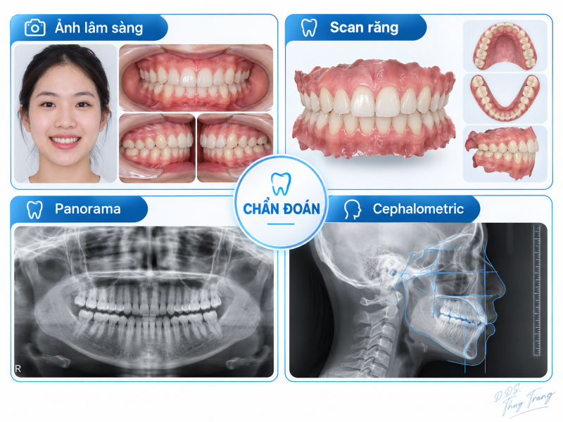 Hồ sơ chẩn đoán chỉnh nha gồm ảnh lâm sàng, scan răng, phim Panorama và phim sọ nghiêng Cephalometric