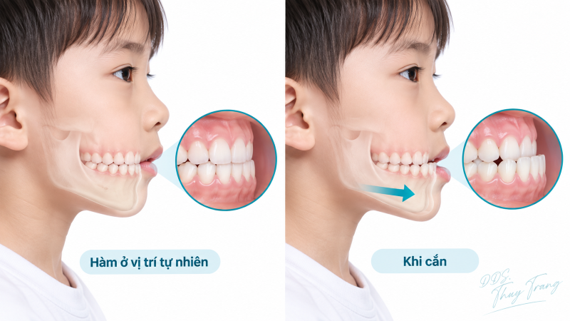 Minh họa móm chức năng ở trẻ khi hàm dưới trượt ra trước lúc cắn