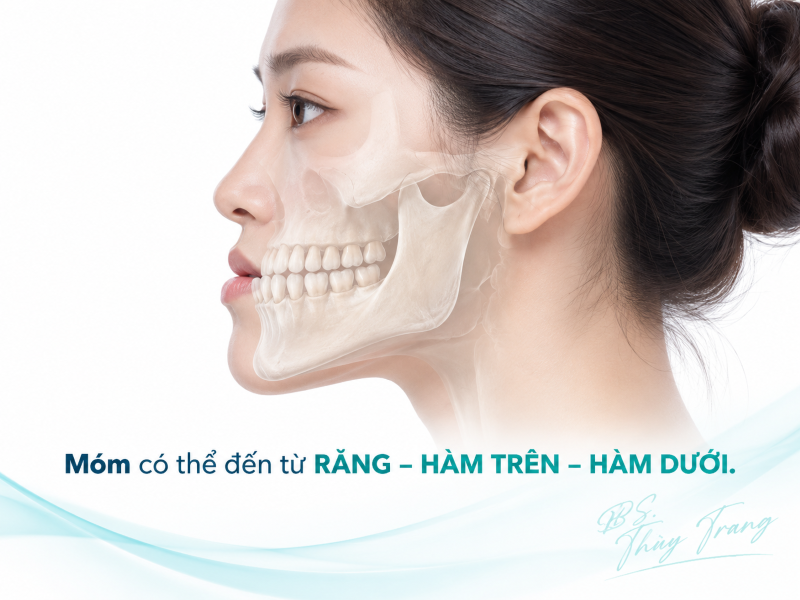 Minh họa tình trạng móm có thể liên quan đến răng, hàm trên hoặc hàm dưới