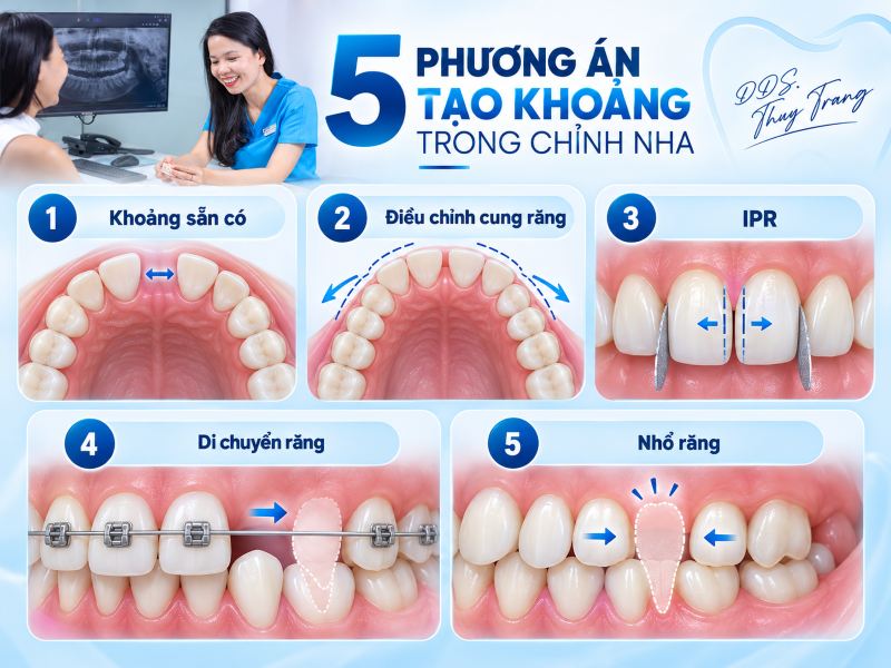Minh họa 5 phương án tạo khoảng trong chỉnh nha gồm khoảng sẵn có, điều chỉnh cung răng, IPR, di chuyển răng và nhổ răng