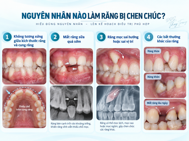 Minh họa các nguyên nhân gây răng chen chúc trong chỉnh nha