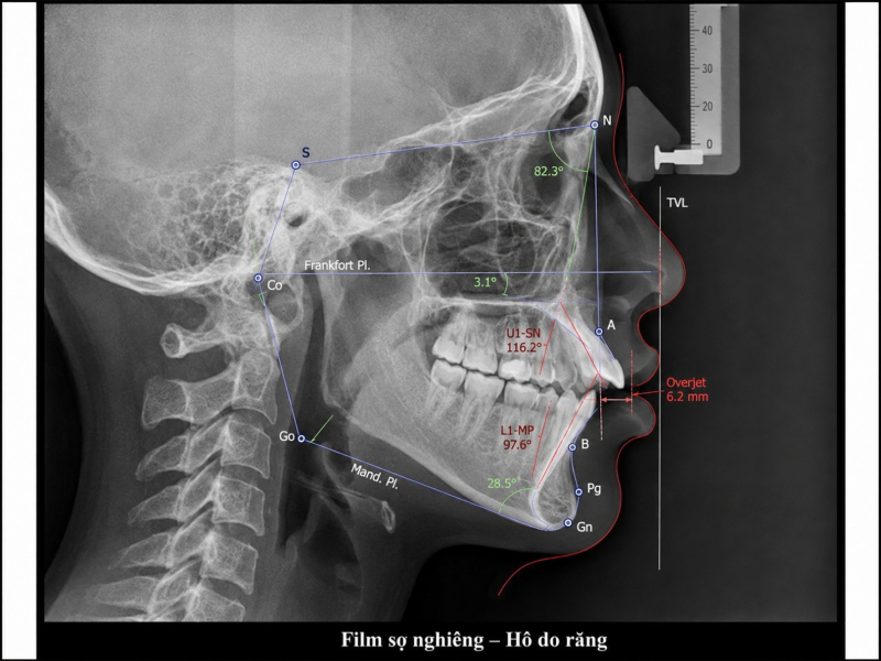 Phim sọ nghiêng cephalometric minh họa trường hợp hô chủ yếu do răng