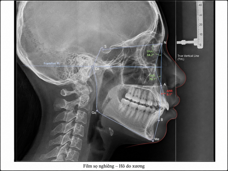 Phim sọ nghiêng cephalometric minh họa trường hợp hô chủ yếu do xương