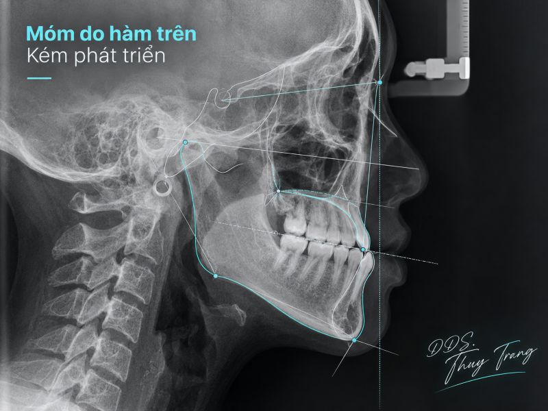 Phim sọ nghiêng minh họa móm do hàm trên kém phát triển