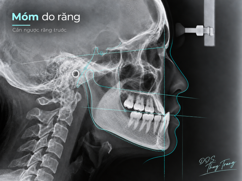 Phim sọ nghiêng minh họa trường hợp móm chủ yếu do răng