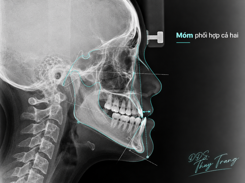 Phim sọ nghiêng minh họa móm phối hợp do hàm trên phía sau và hàm dưới ra trước