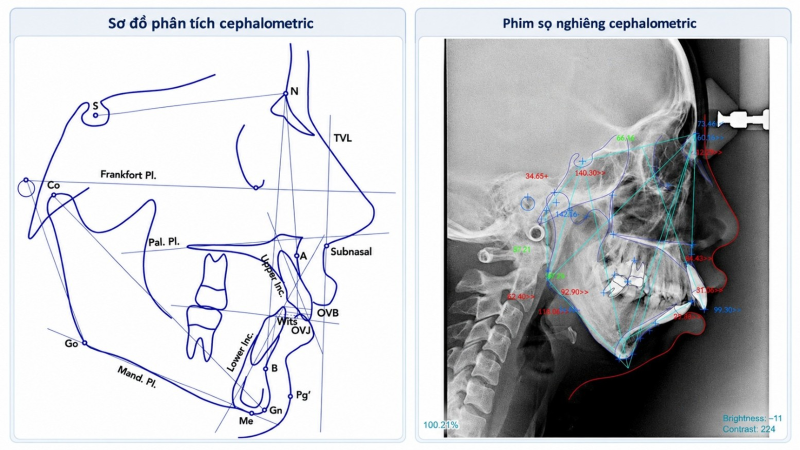 Phim sọ nghiêng và sơ đồ cephalometric dùng để phân tích tương quan xương hàm, vị trí răng cửa và mô mềm trong chẩn đoán hô