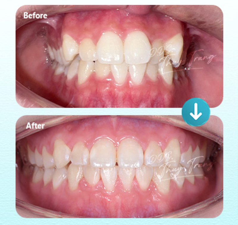 Hình ảnh trước và sau chỉnh nha răng chen chúc cùng BS. Trương Thùy Trang