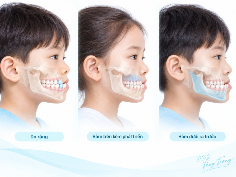 Minh họa các nguyên nhân trẻ bị móm gồm do răng, hàm trên kém phát triển và hàm dưới ra trước
